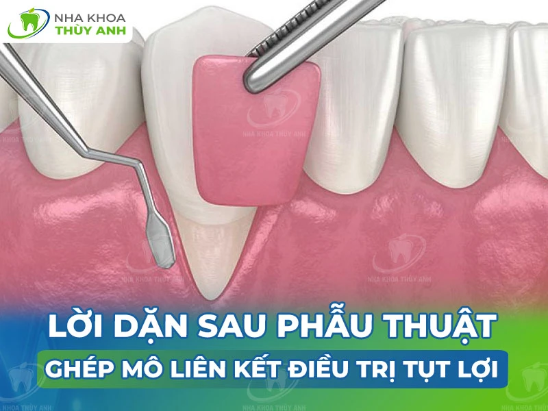 Lời dặn sau phẫu thuật ghép mô liên kết điều trị tụt lợi