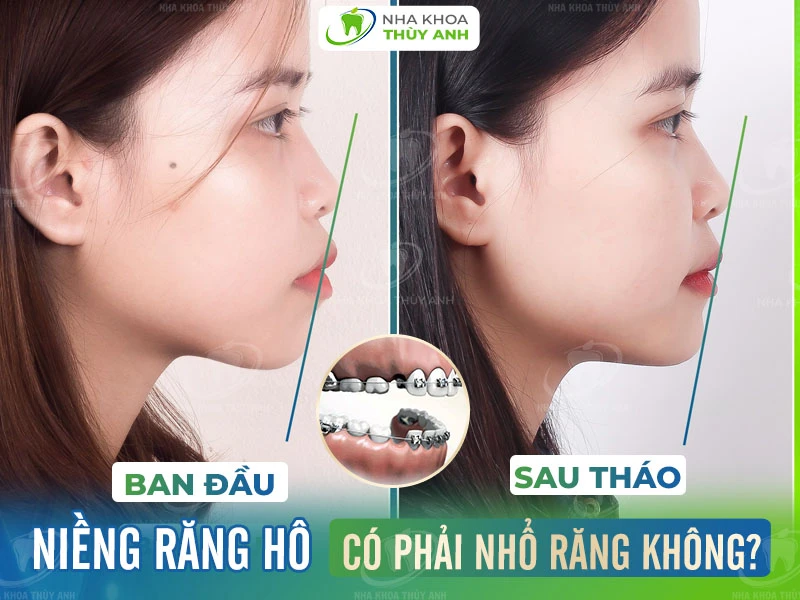 Niềng răng hô có phải nhổ răng không?