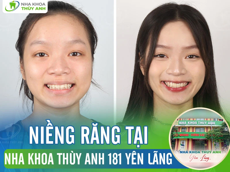 Địa chỉ niềng răng uy tín tại Đống Đa – nha khoa Thùy Anh