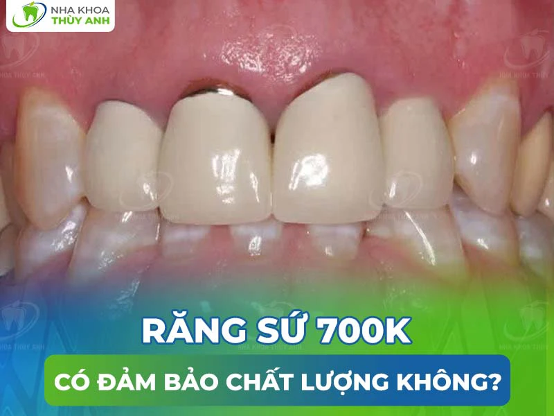 Răng sứ 700k có đảm bảo chất lượng không?