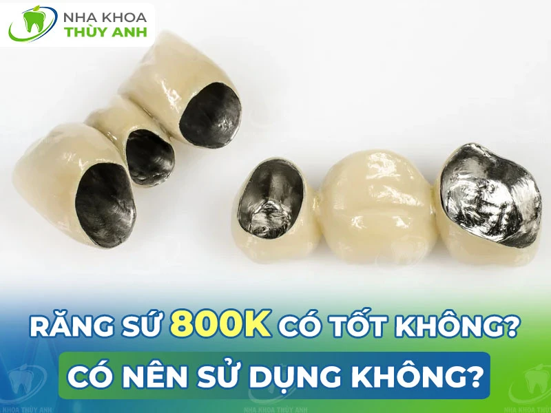 Răng sứ 800k  có tốt không? Có nên sử dụng không?