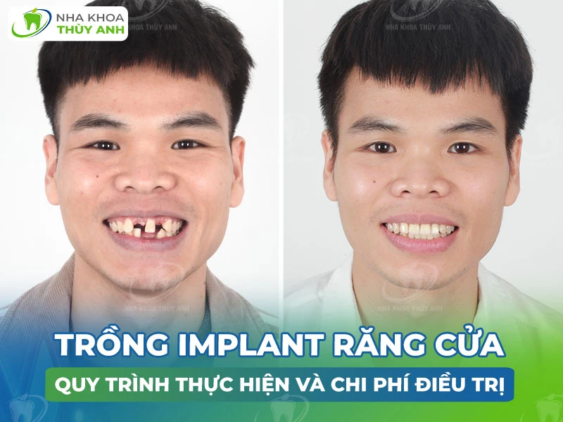 Trồng implant răng cửa: Quy trình thực hiện và chi phí điều trị