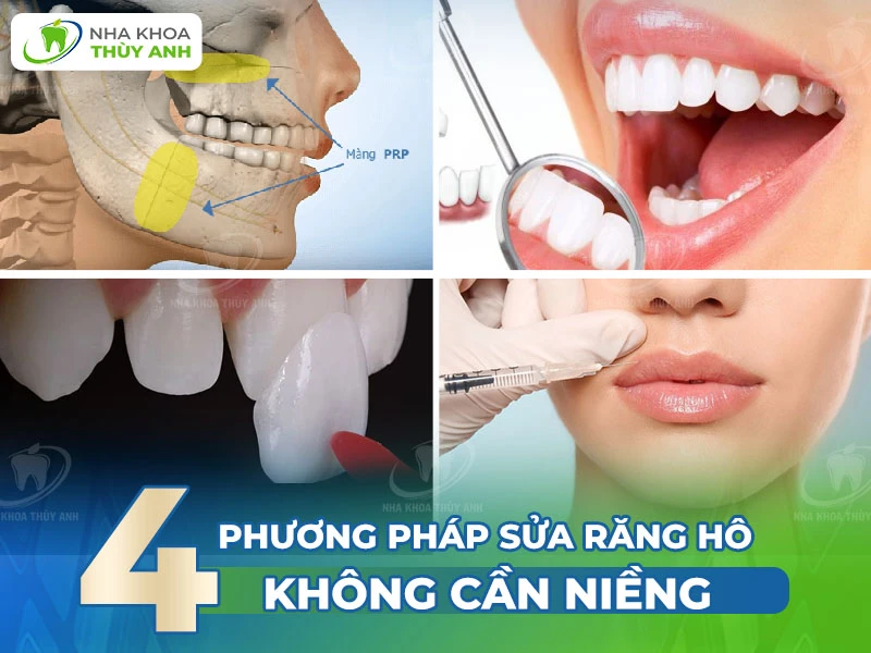 4 phương pháp sửa răng hô không cần niềng