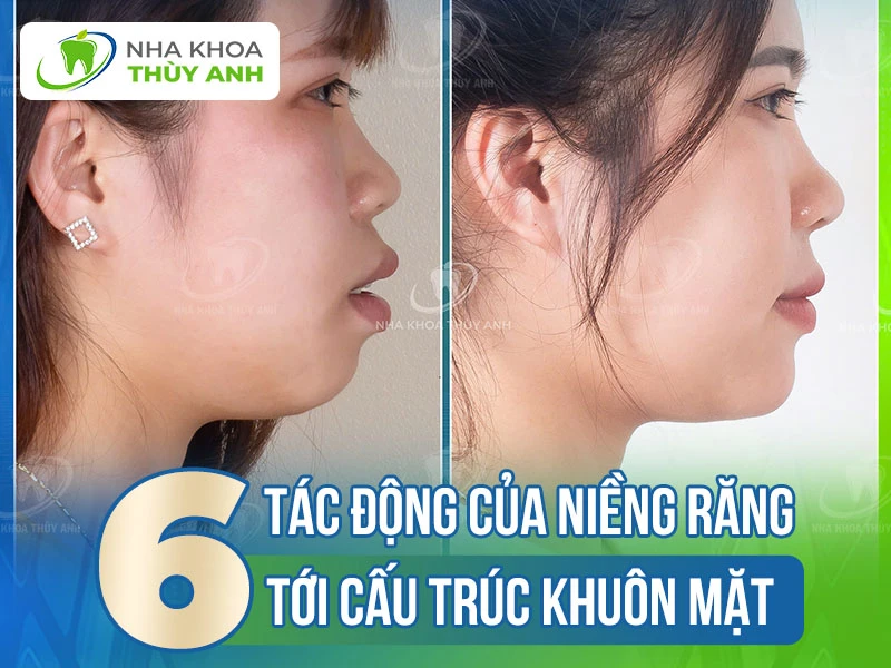 6 tác động của niềng răng tới cấu trúc khuôn mặt