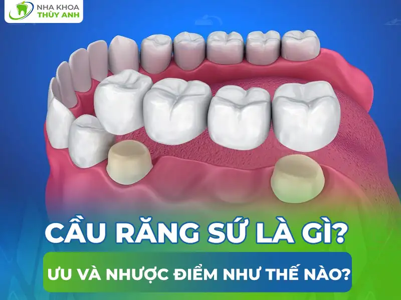 Cầu răng sứ là gì? Ưu và nhược điểm như thế nào?