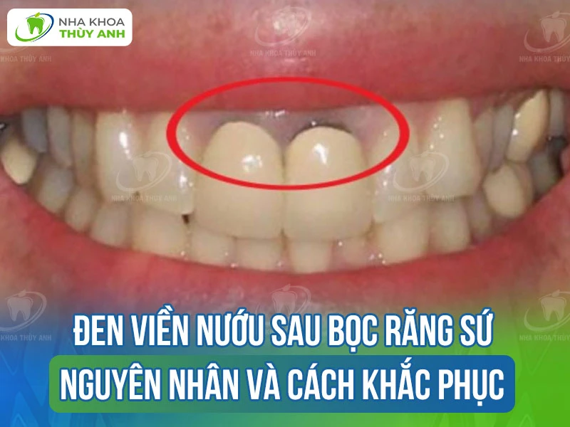 Đen viền nướu sau bọc răng sứ: Nguyên nhân và cách khắc phục