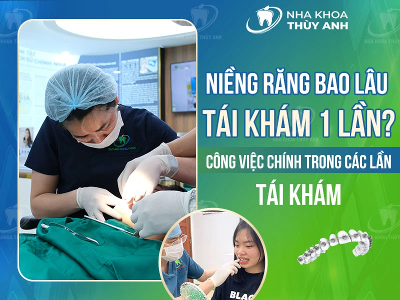 Niềng răng bao lâu tái khám 1 lần? Công việc chính trong các lần tái khám