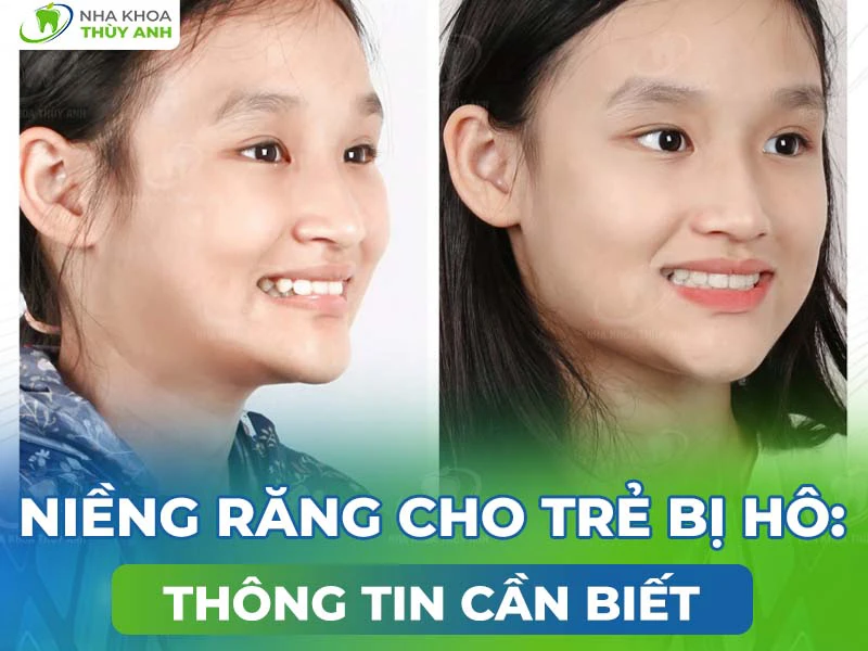 Niềng răng cho trẻ bị hô: Thông tin cần biết