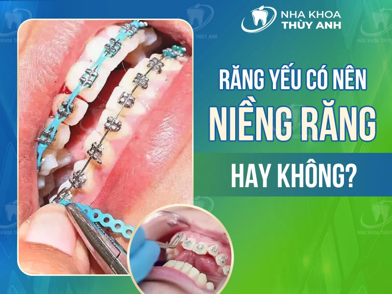 Răng yếu có nên niềng răng không?