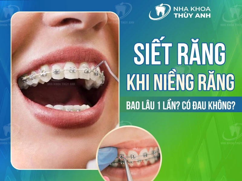 Siết răng khi niềng răng: Bao lâu 1 lần? Có đau không?