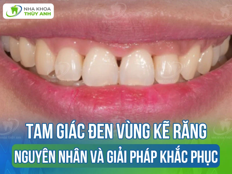 Tam giác đen vùng kẽ răng: Nguyên nhân và giải pháp khắc phục