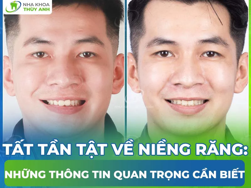 Tất tần tật về niềng răng: Những thông tin quan trọng