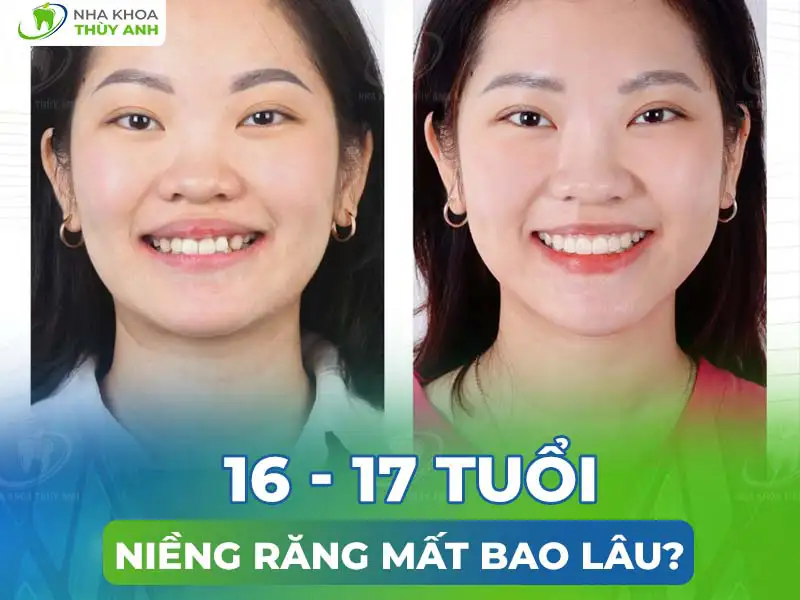 16 – 17 tuổi niềng răng mất bao lâu?