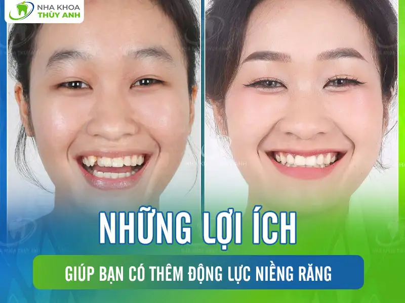 Những lợi ích giúp bạn có thêm động lực niềng răng