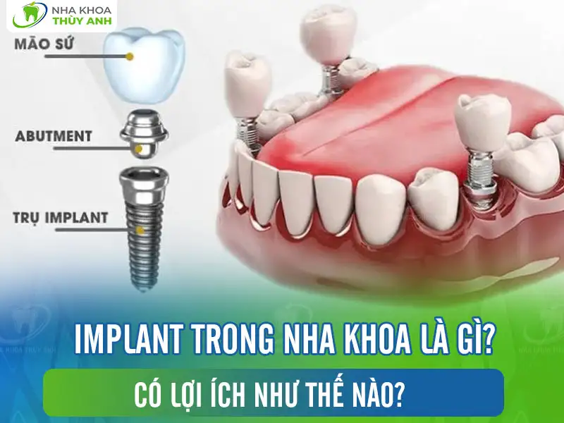 Implant trong nha khoa là gì? Có lợi ích như thế nào?