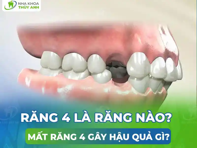 Răng 4 là răng nào? Mất răng 4 gây hậu quả gì?