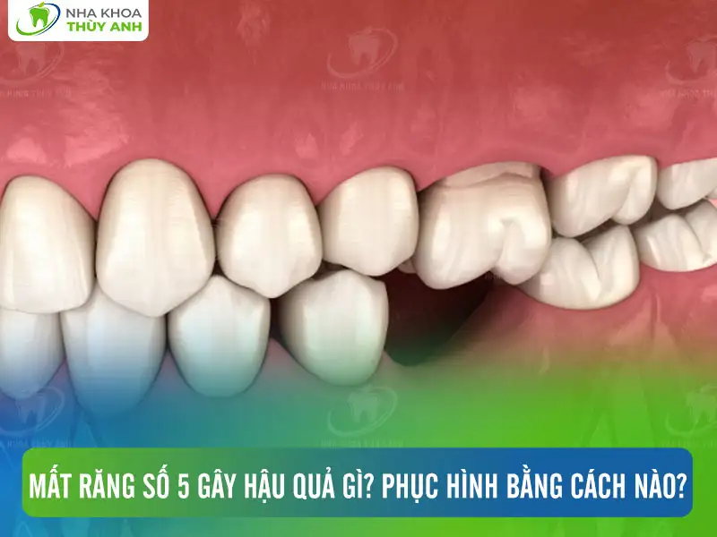 Mất răng số 5 gây hậu quả gì? Phục hình bằng cách nào?