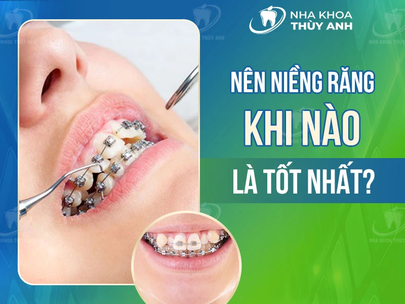 Nên niềng răng khi nào là tốt nhất?