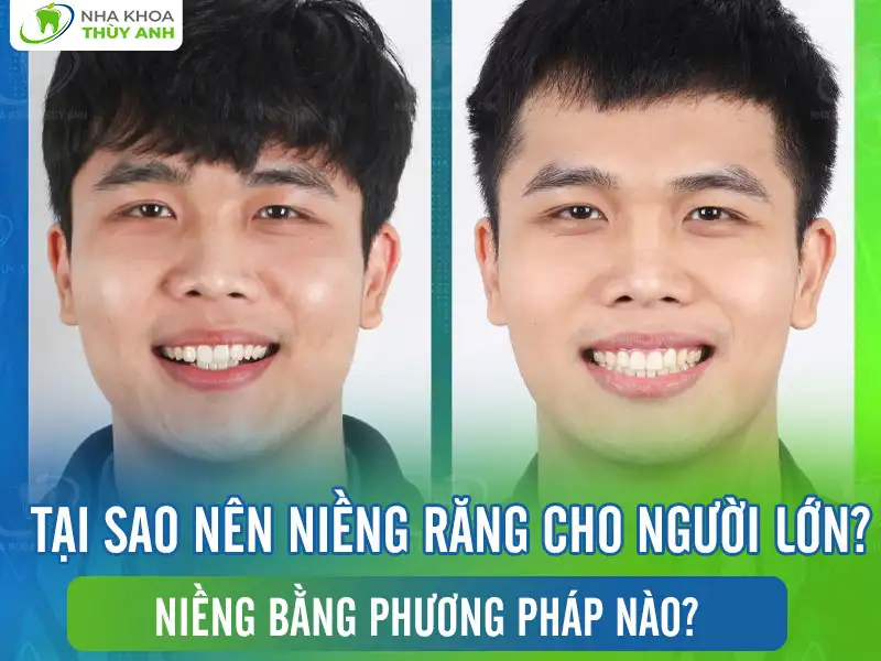 Tại sao nên niềng răng cho người lớn? Niềng bằng phương pháp nào?