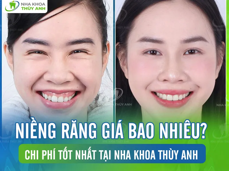 Niềng răng giá bao nhiêu? Chi phí tốt nhất tại nha khoa Thùy Anh