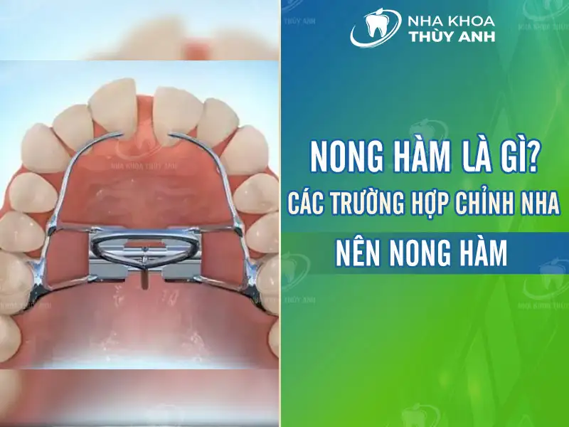 Nong hàm là gì? Các trường hợp chỉnh nha nên nong hàm?