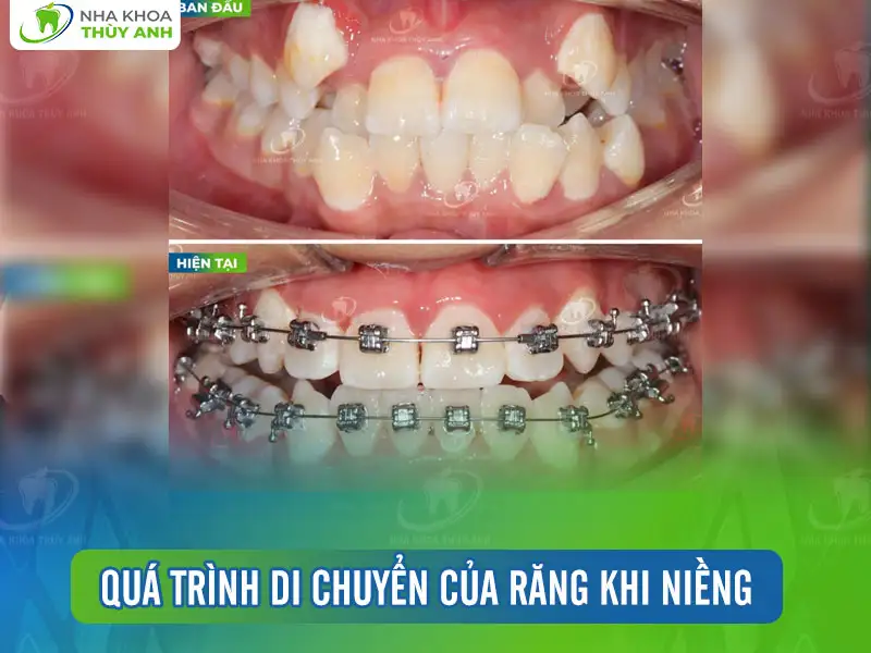 Quá trình di chuyển của răng khi niềng