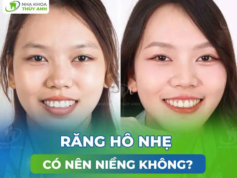 Răng hô nhẹ có nên niềng không?