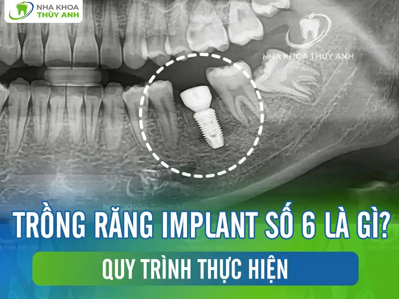 Trồng răng implant số 6 là gì? Quy trình thực hiện