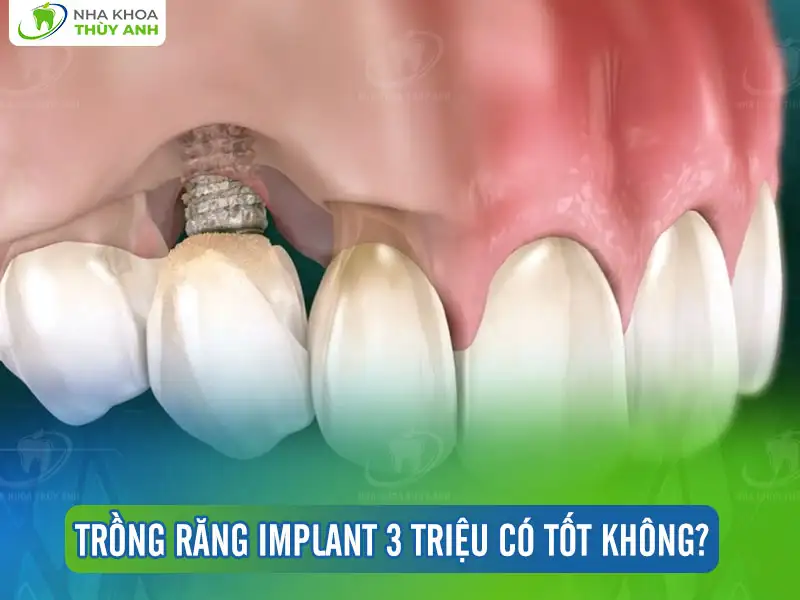 Trồng răng implant 3 triệu có tốt không?