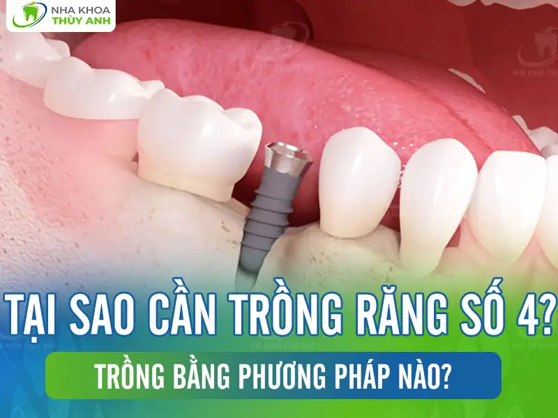 Tại sao cần trồng răng số 4? Trồng bằng phương pháp nào?