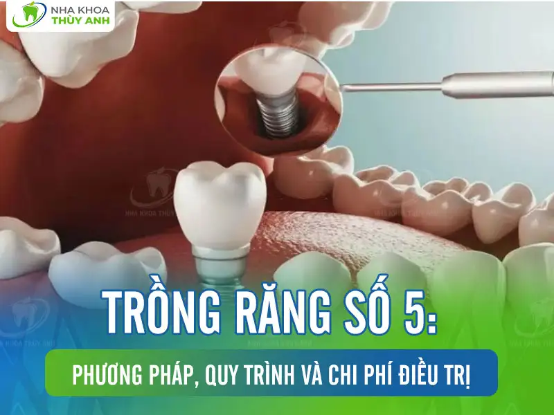 Trồng răng số 5: Phương pháp, quy trình và chi phí điều trị