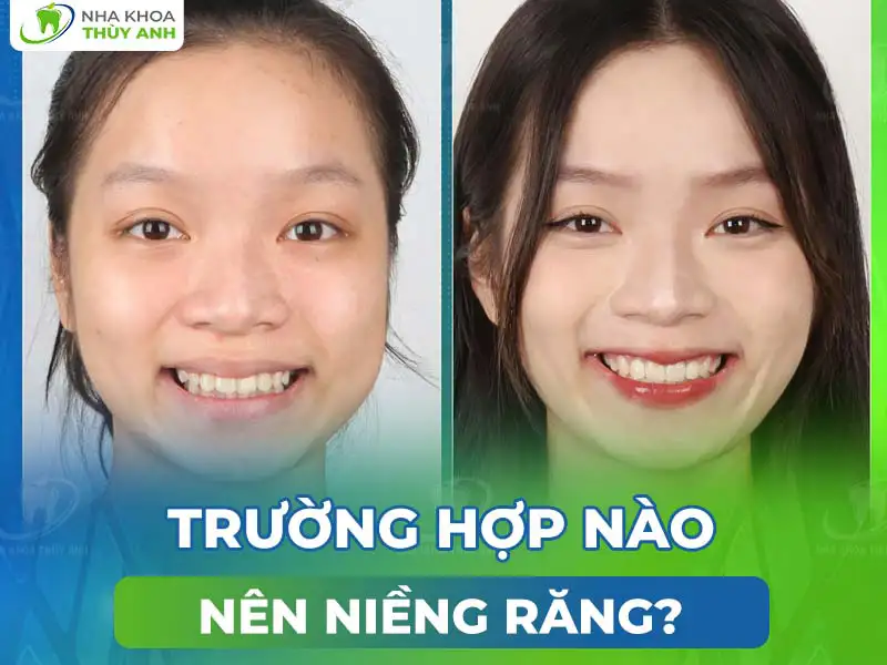 Trường hợp nào nên niềng răng?