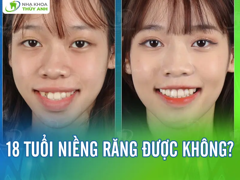 18 tuổi niềng răng được không? Lợi ích khi niềng răng ở tuổi 18