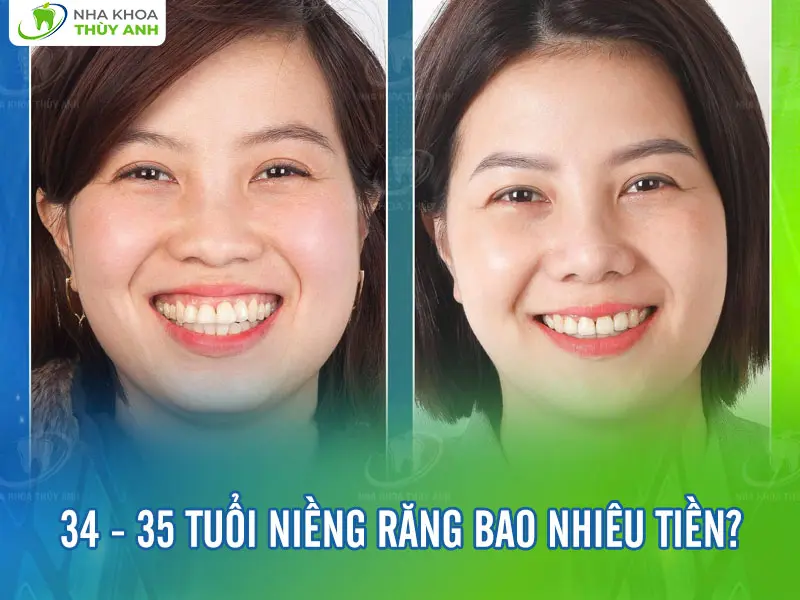 34 – 35 tuổi niềng răng bao nhiêu tiền?