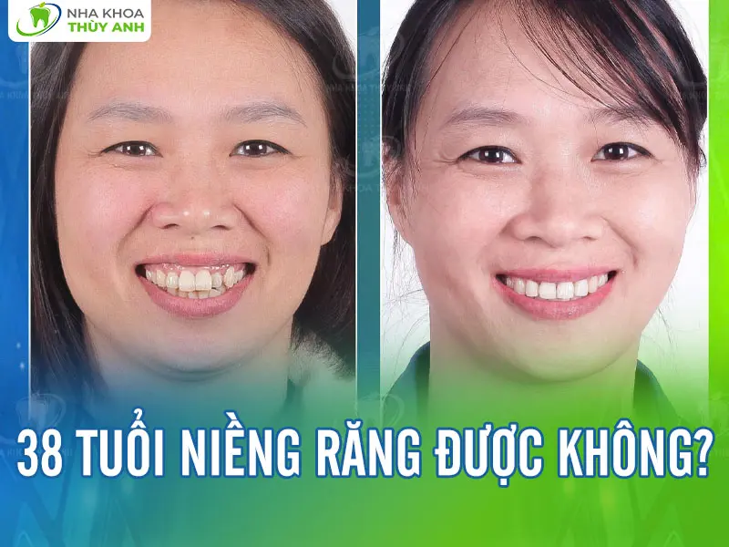 38 tuổi có niềng răng được không?