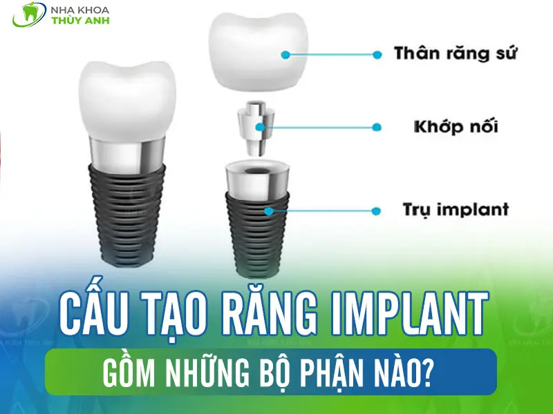 Cấu tạo răng implant gồm những bộ phận nào?