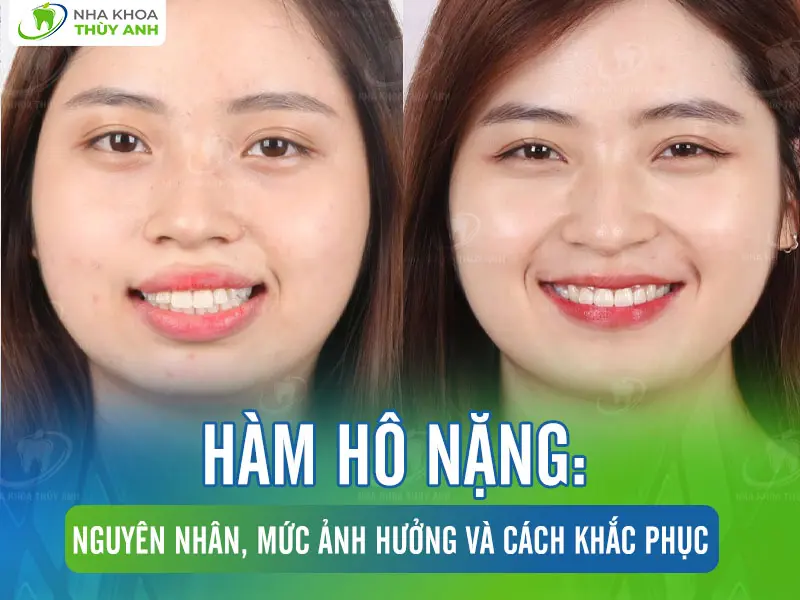 Hàm hô nặng: Nguyên nhân, mức ảnh hưởng và cách khắc phục