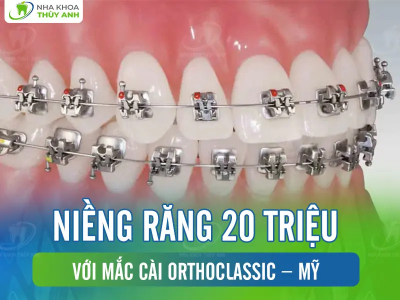 Niềng răng 20 triệu với mắc cài OrthoClassic – Mỹ