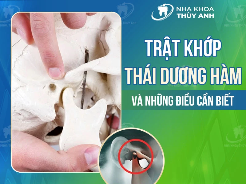 Trật khớp thái dương hàm và những điều cần biết