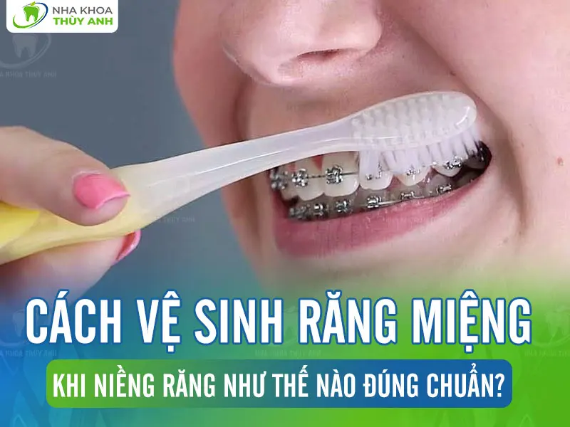 Cách vệ sinh răng miệng khi niềng răng như thế nào đúng chuẩn?