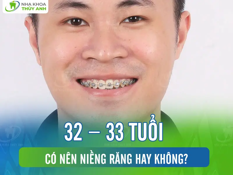 32 – 33 tuổi có nên niềng răng hay không?