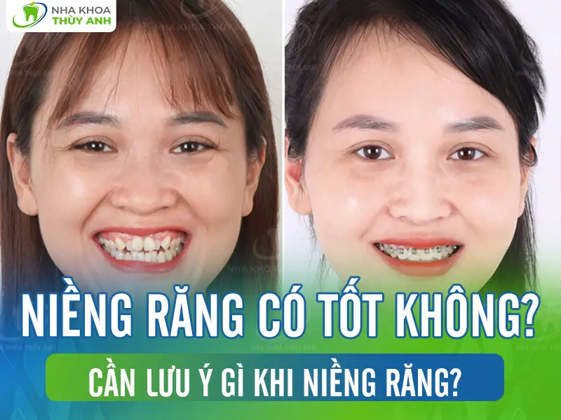 Niềng răng có tốt không? Cần lưu ý gì khi niềng răng?