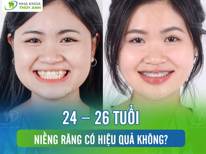 24 – 26 tuổi niềng răng có hiệu quả không?