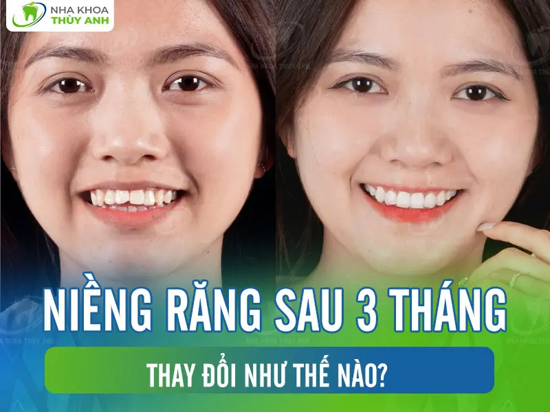 Niềng răng sau 3 tháng thay đổi như thế nào?