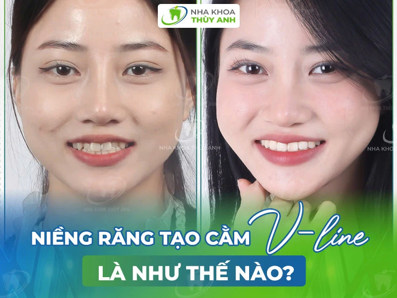 Niềng răng tạo cằm V – line là như thế nào?