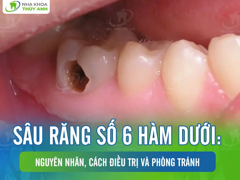 Sâu răng số 6 hàm dưới: Nguyên nhân, cách điều trị và phòng tránh