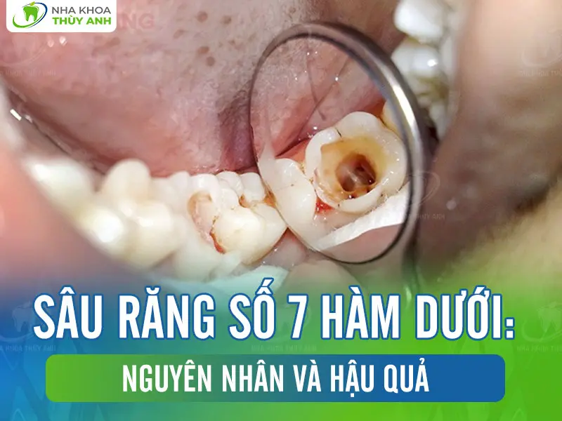 Sâu răng số 7 hàm dưới: Nguyên nhân và hậu quả