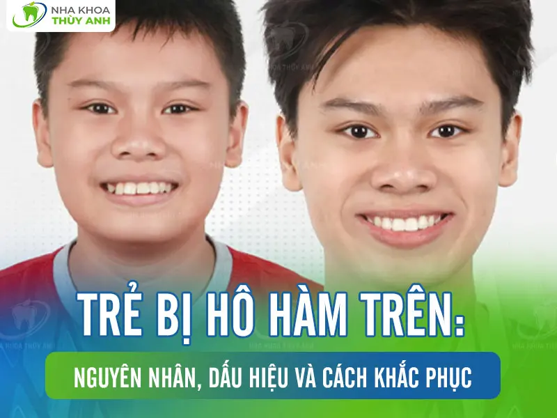 Trẻ bị hô hàm trên: Nguyên nhân, dấu hiệu và cách khắc phục