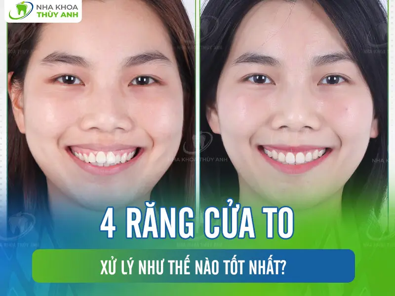 4 răng cửa to xử lý như thế nào tốt nhất?