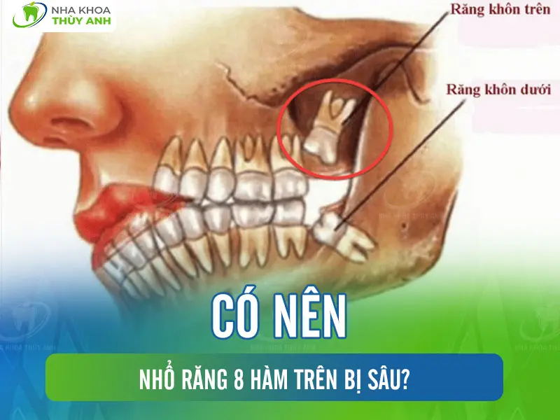 Có nên nhổ răng số 8 hàm trên bị sâu?